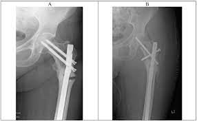 a radiograph on admission march 2016
