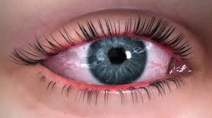 treating ocular rosacea the dry eye