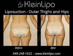 outer thighs liposuction kleinlipo