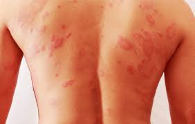 how to treat 4 common rashes men s health