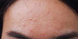 fungal acne causes symptoms