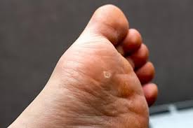 plantar wart treatment foot doctor