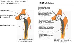 scyon orthopaedics hip replacement