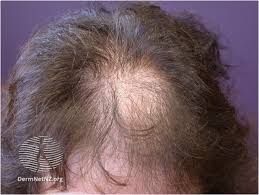 alopecia refhelp