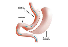 gastric sleeve and nutrition