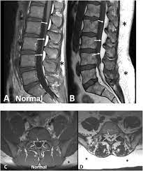 lumbar spinal epidural lipomatosis a