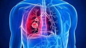 Hasil gambar untuk kanker paru paru