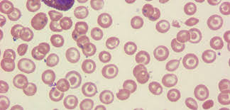 Morphological Abnormalities Of Red Blood Cells The Art Of