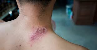 shingles vs herpes symptoms causes