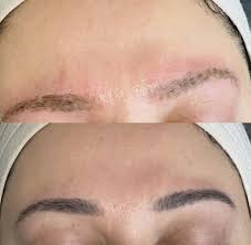 brow tattoo laser removal