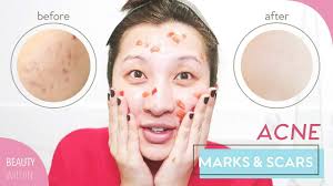 remove acne marks hyperpigmentation