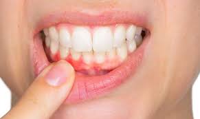 recover from gum graft surgery