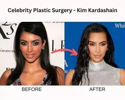 celebrity plastic surgery 51 before