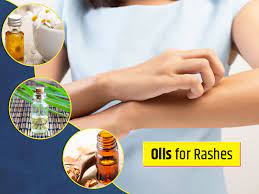 essential oils for rashes