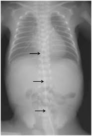 Nodules, masses, and tumors quick summary of terminology: Interpretation Of Neonatal Chest Radiography