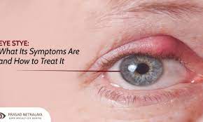 what causes styes in the eye prasad