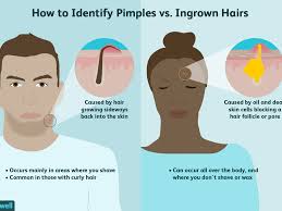 How to stop ingrown hairs & razor bumps while waxing & shaving | best treatments & products for ingrown hair, ingrown hair black | darks skin, how to cure in. Difference Between A Pimple And An Ingrown Hair