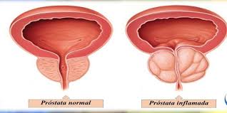 Resultado de imagen de fotos de la prostata