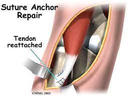 what is a biceps tendon rupture and how