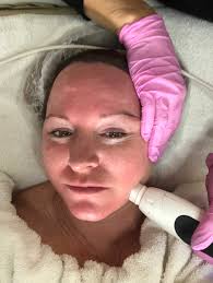 Here you can find a summery of information, picked from recommendations in to the question how often should microneedling treatment be done one find different answers. Microneedling Ideal Against Wrinkles And Hair Loss But Not For Everyone Wowwatchers