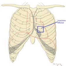 Pain under the right rib cage has a large number of reasons. Precordial Catch Syndrome Wikipedia
