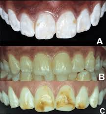 Dental fluorosis is a condition that causes changes in the appearance of tooth enamel. Management Of Stained Fluorotic Teeth By Combined Minimal Invasive Esthetic Procedure Case Series Journal Of Dentistry Open Access Science Repository Open Access