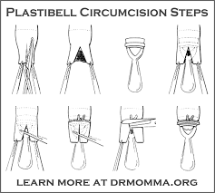 Pin On How Circumcision Happens