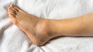 sprained ankle symptoms diagnosis