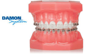 How to stop braces pain fast. The Truth About Damon Braces Read Here For All You Need To Know