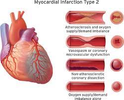 .myocardial infarction mortality 1.0 introduction in the uk, about 838,000 men and 394,000 women have had a myocardial infarction (mi) at some point in their lives, (nice clinical guideline 48, 2007). Fourth Universal Definition Of Myocardial Infarction 2018 Circulation