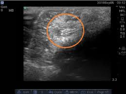 lipoma outlined by ultrasound image