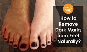remove dark marks from feet naturally