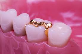Gold, Ceramic and Composite: A Restorative Dental Material Discussion -  Spear Education