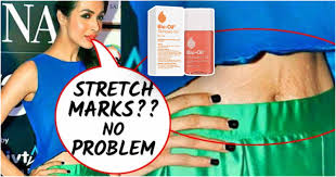 creams and oils to fade stretch marks