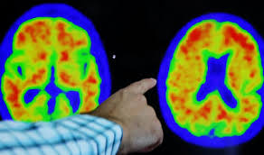 us removes coverage curb on pet scans