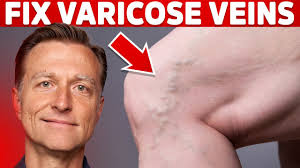 how to treat varicose veins naturally