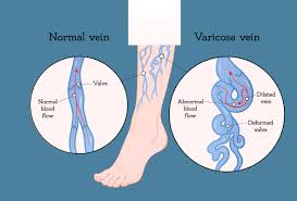 11 home remes for varicose veins