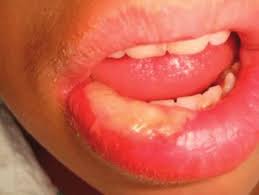 lip biting after a dental procedure