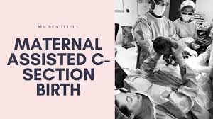 maternal isted c section birth lyz