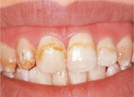 In this post, i will talk about the various treatments for dental fluorosis. 4 Bleaching Of Teeth Affected By Specific Conditions Pocket Dentistry