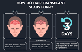 hair transplant scabs what are they
