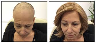 hair loss due to chemotherapy hairhotel