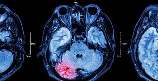 A stroke, also referred to as a cerebral vascular accident (cva) or a brain attack, is an fewer strokes are categorized as hemorrhagic, which occur when weakened blood vessels inside the brain. Real World Stroke With Tavr Tvt Registry Insights Rekindle Cerebral Protection Debate Tctmd Com