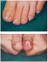 pincer nail deformity inherited and