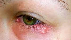 infected eye 8 common causes