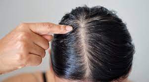 home remes for oily scalp to treat