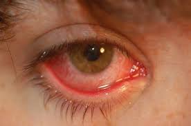 ocular infections springerlink
