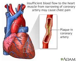 coronary artery spasm symptoms and causes