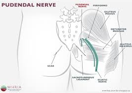 pudendal neuralgia treatment symptoms