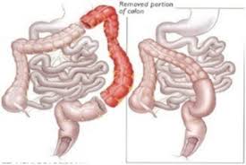 colectomy colorectal clinic of michigan